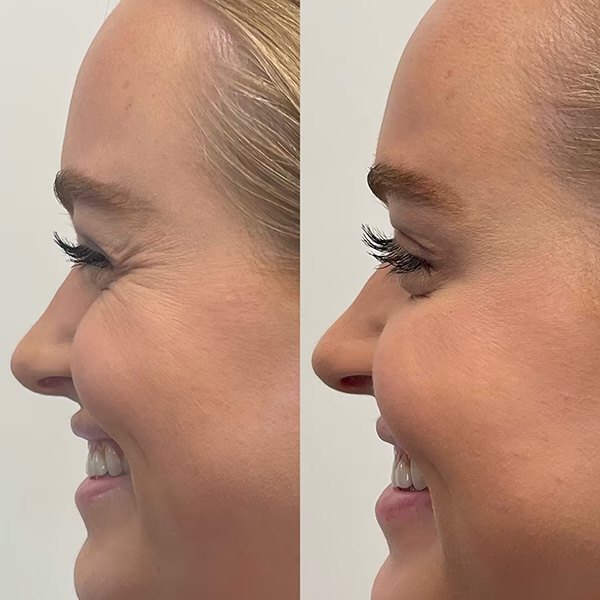 BOTOX for crow's feet, before and after at Coastal Medical Aesthetics