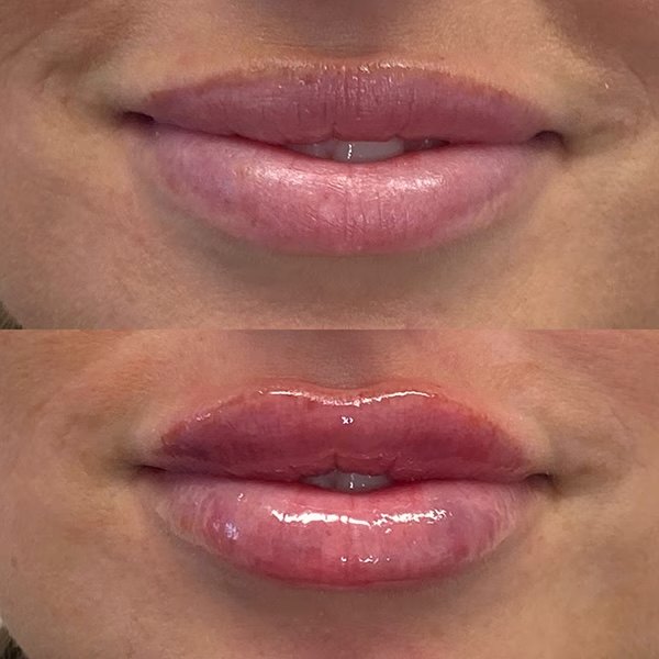 Juvederm Ultra lip filler, before and after at Coastal Medical Aesthetics