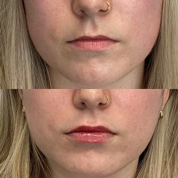Restylane Kysse lip filler, before and after at Coastal Medical Aesthetics